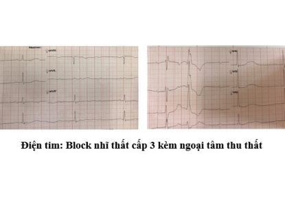 Đặt máy tạo nhịp tim cấp cứu ở người cao tuổi có nguy cơ cao