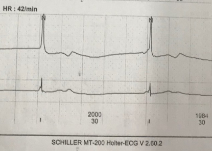 Nhân một trường hợp nhịp tim chậm do thuốc chống loạn nhịp tim