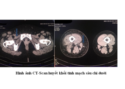 Huyết khối tĩnh mạch sâu chi dưới mức độ nặng sau chấn thương ở người trẻ tuổi