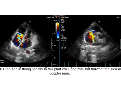 Điều trị bệnh tim bẩm sinh thông liên nhĩ bằng dù Amplatzer